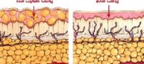 سلولیت چیست و چگونه بوجود می آید؟