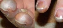 اگر دچار سرما زدگی شده اید بخوانید