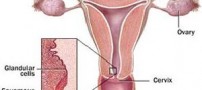 ترشحات غیرطبیعی زنان چگونه است؟