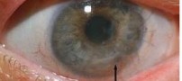 بیماری التهاب قرنیه چشم