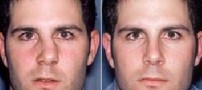 بررسی علل شکستگی بینی و درمان آن