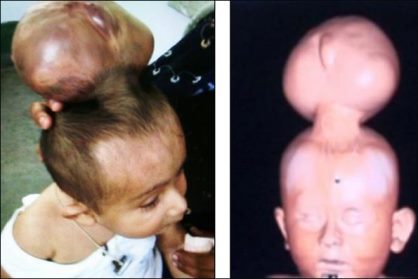 این کودک دو سر بعد از 8 ماه سرش جدا شد (عکس)