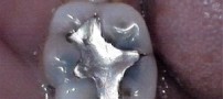 آشنایی با آمالگام، ماده پرکننده نقره‌ای‌رنگ دندان
