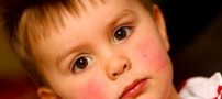 با قرمزی پوست صورتم چه کنم؟