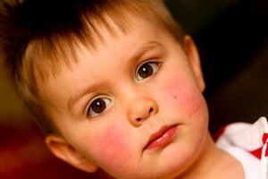 با قرمزی پوست صورتم چه کنم؟