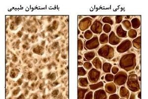 راه هایی برای فرار از پوکی استخوان