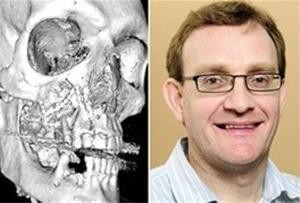 مردی با سقف دهان ، حدقه چشم و ارواره پیچی