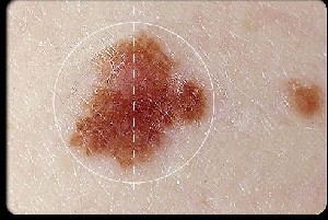 آیا صورت یا بدنتان خال دارد؟