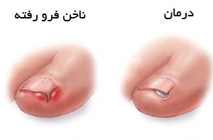 درمان ناخن فرو رفته در گوشت