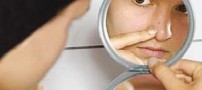 جوش یا آكنه یكی از شایع‌ ترین مشكلات پوستی