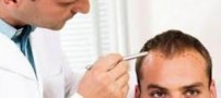 درباره کاشت موی طبیعی چه میدانید؟