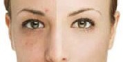 روشهایی برای از بین بردن لکه های سیاه پوست