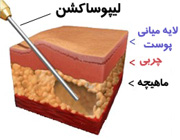 لیپوساكشن هیچ فایده ای ندارد