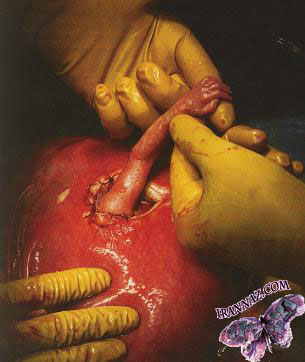 نوزادی که از داخل رحم دست پزشک را گرفت!!(همراه با عکس)