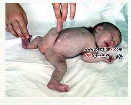 کودکی بسیار عجیب که هم دختر است و هم پسر !!!