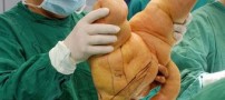 عجیب ترین دست دنیا با 10 کیلو وزن و 30 سانتیمتر قد