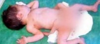 تولد انسانی چهار پا با جنسیتی نا مشخص
