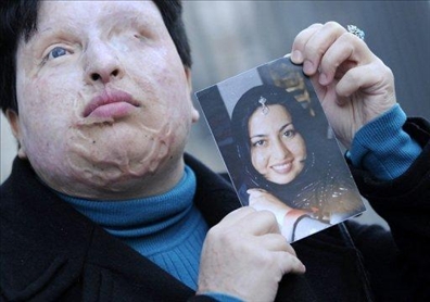 مجازات اسید پاش به تعویق افتاد + عکسهای دردناک مجازات اسید پاش به تعویق افتاد + عکسهای دردناک