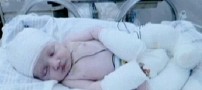 نوزادی که با بدنی سوخته متولد شد!! +عکس