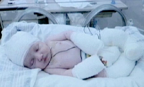 نوزادی که با بدنی سوخته متولد شد!! +عکس