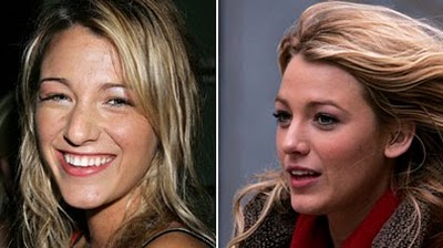 عکس هایی از قبل و بعد از عمل زیبایی بینی بازیگران