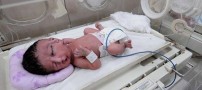 تولد نوزادی بسیار عجیب با دو صورت و چهره +عکس