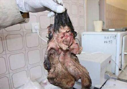 خارج کردن یک جنین از بدن پسر 22 ساله!!! (تصویری) ، www.irannaz.com