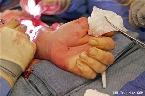 پیوند دو دست یک جنازه به یک انسان زنده!! +عکس پیوند دو دست یک جنازه به یک انسان زنده!! +عکس