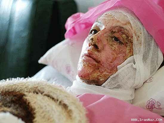 ماجرای تکراری و تکان دهنده یک اسید پاشی +تصاویر ماجرای تکراری و تکان دهنده یک اسید پاشی +تصاویر