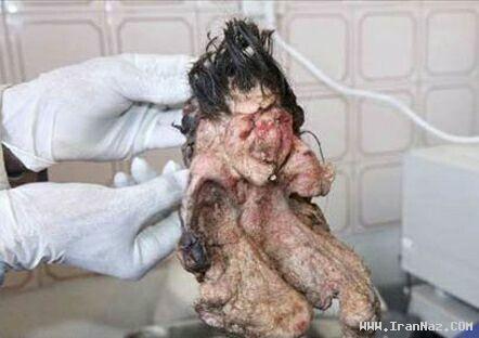 خارج کردن یک جنین از بدن پسر 22 ساله!!! (تصویری) ، www.irannaz.com