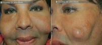 تزریق سیمان بجای ژل زیبایی به گونه یک زن! +عکس