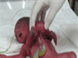 تولد نوزادی با 4 پا و 2 دست در قوچان!!+عکس