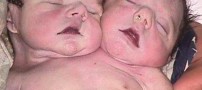 عکس های دیدنی از همه دوقلوهای به هم چسبیده!