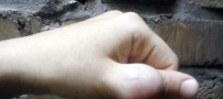 بیماری بسیار وحشتناک دختر 18 ساله ایرانی +عکس