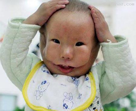 به دنیا آمدن کودکی بسیار عجیب با دو صورت! +تصاویر