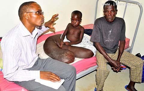 بیماری وحشتناک و عجیب پسر بچه اوگاندایی +عکس