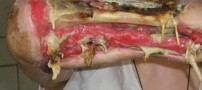 اثرات بسیار وحشتناك مخدر كروكودیل! +تصاویر (18+)
