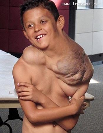 پسری با تومور وحشتناک و عجیب در گردنش! +عکس