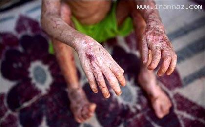 بیماری دردناک و باورنکردنی یک دختر ایرانی!! +تصاویر