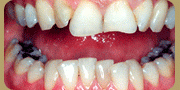 آیا دندان های شما نامرتب است ؟