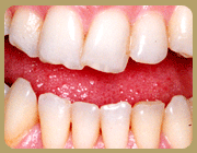 آیا دندان های شما نامرتب است ؟